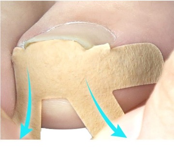 4 x PATCH STRIPES от вросших ногтей, патчи