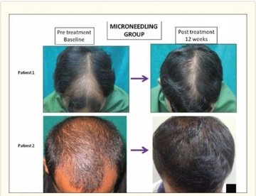 Derma Roller МЕЗОТЕРАПИЯ ДЛЯ ГУСТОЙ БОРОДЫ Масло для бороды Aichun поддерживает рост