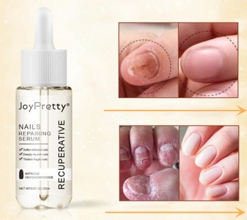 2 × Сильная жидкость для восстановления ногтей от грибка ногтей