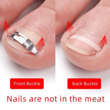 Инструменты для лечения вросших ногтей на ногах, набор для обработки вросших ногтей из углеродистой стали C