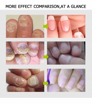 ЭФЕРО Гель для ухода за ногтями 20г