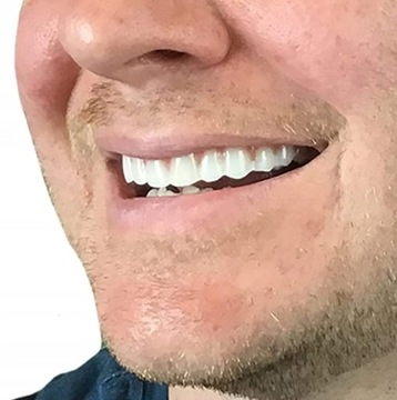 Верхние и нижние виниры для изучающих зубов Smile.