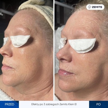 Аппарат для электропорации Zemits Klein EL