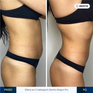 Кавитационный аппарат Zemits Abigon Pro