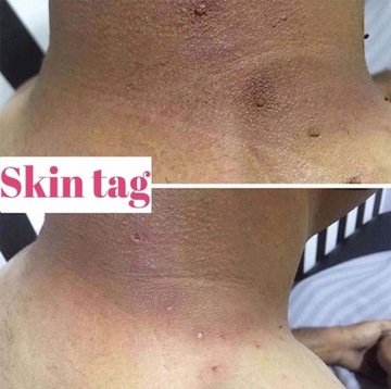 Мазь для удаления кондилом вульвы и бородавок