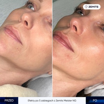 Антивозрастная терапия для лица комбайн 8в1 Zemits Meister NG