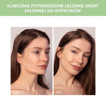 FOREO ESPADA 2 PLUS средство для лечения и удаления прыщей