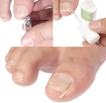 Силиконовые полосы для вросших ногтей 10 ПК + Подология зонд