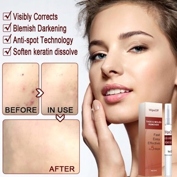 Средство для удаления родинок и бородавок