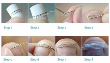 НАБОР ДЛЯ КОРРЕКЦИИ ВРАСТНЫХ НОГТЕЙ