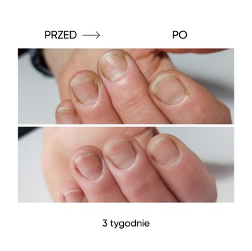 Olejek regenerujący przy onycholizie NOTD Onistop