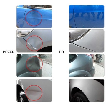 НАБОР ДЛЯ УДАЛЕНИЯ ВМЯТИН НА ТЕЛЕ