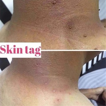 Против родинок и генитальных бородавок