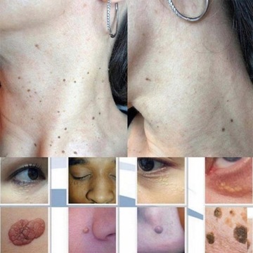 Мазь для удаления кондилом вульвы и бородавок