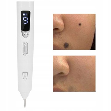 LASER PEN PLASMA TATTOO REMOVAL OF WIP SCARS