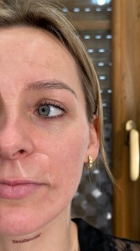 Skinremide Патчи от морщин для лица MIX формы 165 шт.