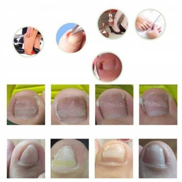 Пластыри для исправления вросших ногтей. Оформление ногтей