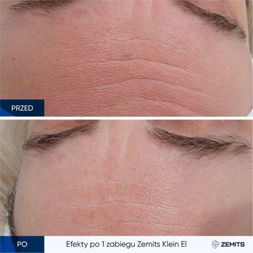 Аппарат для электропорации Zemits Klein EL