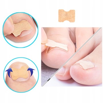 120 SZT PASKI PLASTRY ŁATKI NA WRASTAJĄCE PAZNOKCIE