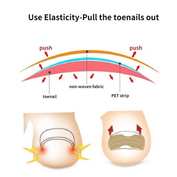 10 полосок пластырей от вросших ногтей на ногах.
