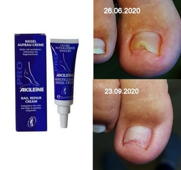 AKILEINE PRO крем Онихолиз для регенерации и реконструкции ногтей 10 мл