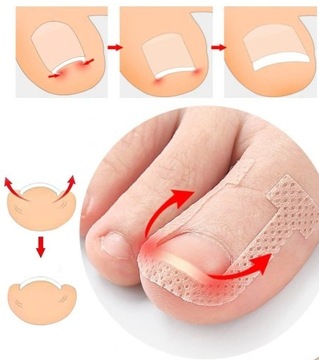 Paski na wrastające paznokcie | Ulga | 20 sztuk