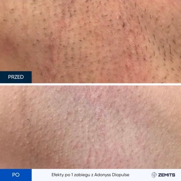 Adonyss DioPulse 808 Диодный лазер для эпиляции