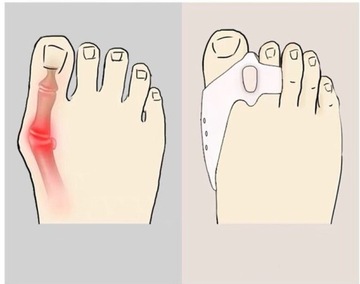 ГЕЛЕВЫЙ СЕПАРАТОР ДЛЯ ЗДОРОВЫХ ПАЛЬЦЕВ ДЛЯ HALLUXES
