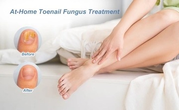 ДОМАШНИЙ СИНИЙ ИНФРАКРАСНЫЙ ЛАЗЕР 470 НМ ДЛЯ ЛЕЧЕНИЯ МИКОЗА НОГТЕЙ