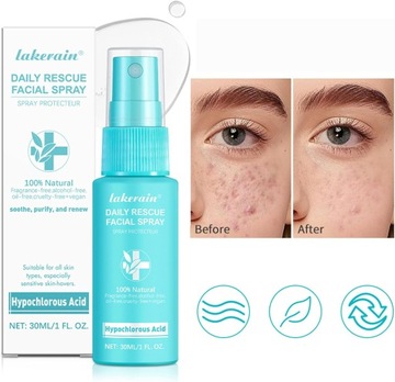 1 ПК с брызги с гипохлористой кислотой для всех типов кожи