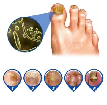 LASEROWE URZĄDZENIE DO LECZENIA GRZYBICY PAZNOKCI