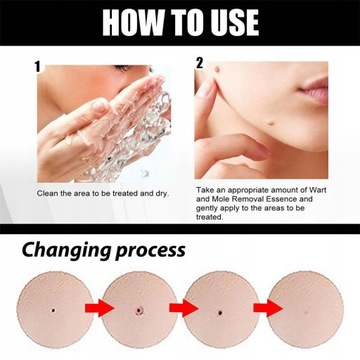 Удаление родинок на коже Удаление бородавок