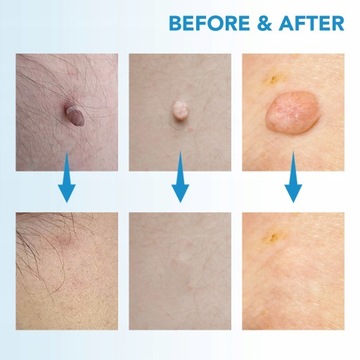 2 в 1 набор для автоматического удаления меток с кожи Micro Skin Tag