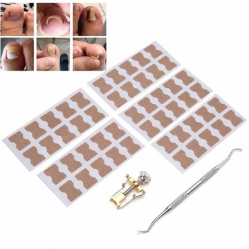 КОНСИЛЕР ДЛЯ ВРАСТНЫХ НОГТЕЙ. КОНСИЛЕР ДЛЯ ВРАСТНЫХ НОГТЕЙ.