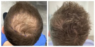 ДЕРМА РОЛИК для волос для роста волос уменьшает облысение кожи головы