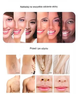 Nd Yag Laser 4in1 IQPRO Удаление волос с татуировкой Электролиз OPT IPL