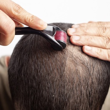 ДЕРМАРОЛИКОВОЕ ОБЛЕСЫВАНИЕ, ГУСТАЯ БОРОДА, МЕЗОТЕРАПИЯ, ВОЛОСЫ