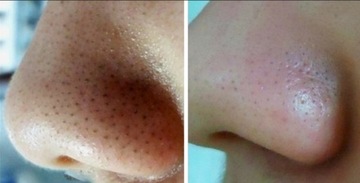 Аппарат для удаления черных точек и выдавливания прыщей - КОМПЛЕКТ