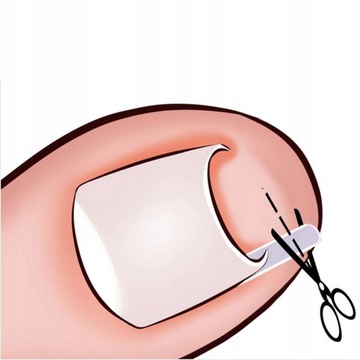 ПРОФЕССИОНАЛЬНЫЕ ЗАЖИМЫ ДЛЯ ВРАСТЫВАЮЩИХ НОГТЕЙ