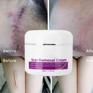 ELAIMEI Крем для удаления шрамов Удаление растяжек