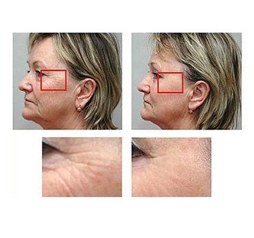 MNS DERMA РОЛИК 192 - ТРУБКА 2,0 мм