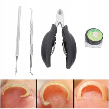 ПРОФЕССИОНАЛЬНЫЕ ЗАЖИМЫ ДЛЯ ВРАСТЫВАЮЩИХ НОГТЕЙ