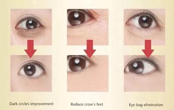 HIFU Multifunction Skin Care Ultrasonic FaceBeauty