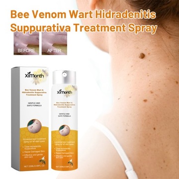 Лечение бородавок пчелиным ядом Hidradenitis Suppurativa Spray Remove Means