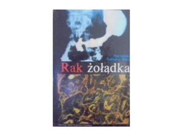 Rak żołądka - T. Popieli