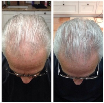 Инфракрасный шлем для роста волос Рост волос