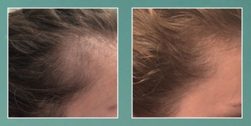 Энзимный пилинг кожи головы 50 мл TRICHO T-derm Series