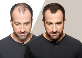 SZampon TOPPIK 250ml - Pogrubienie włosów,łysienie