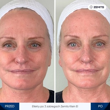 Аппарат для электропорации Zemits Klein EL