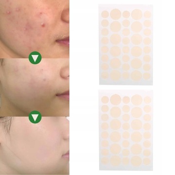 ПАТЧИ ОТ АКНЕ ОТ Прыщей 144 ШТ.